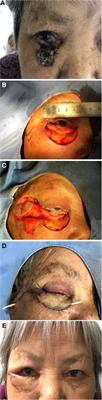 Case report: Lower eyelid Reconstruction with the rotation flap pedicled by orbicularis oculi muscle